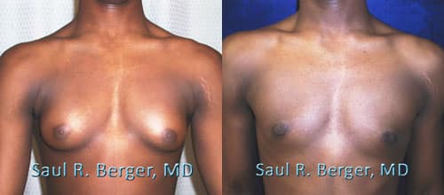 breast reduction for males