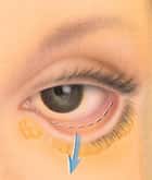 blepharoplasty 5