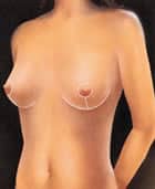 breast lift5