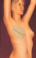 breast reconstruction1