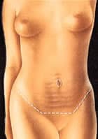 tummytuck 1