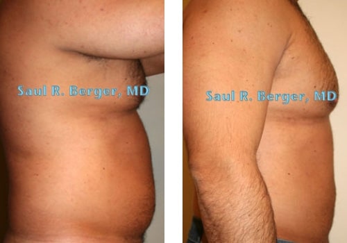 male plastic surgery liposuction