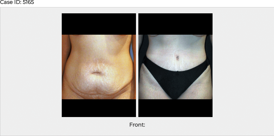 Before & After Tummy Tuck Photo