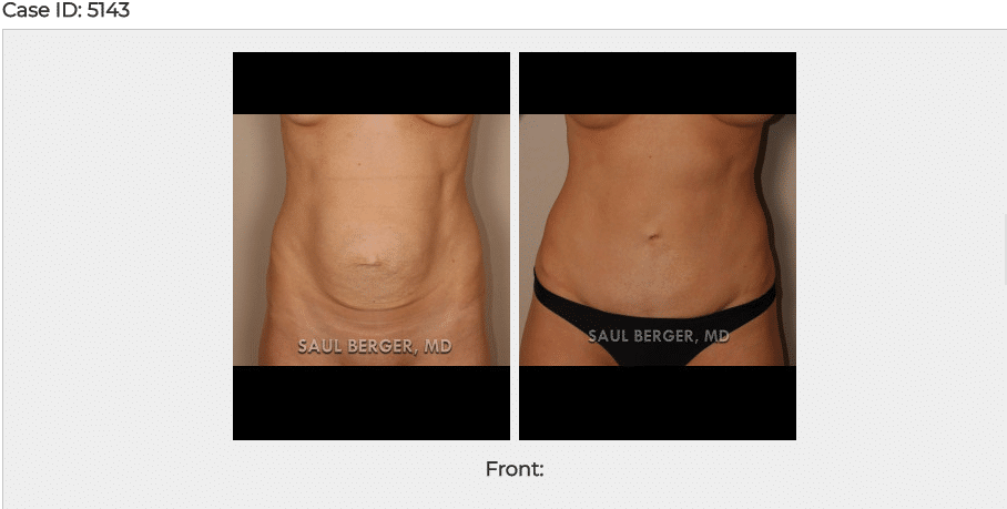 Before & After Tummy Tuck Photos- Case 3