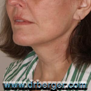 Face/Neck Lift