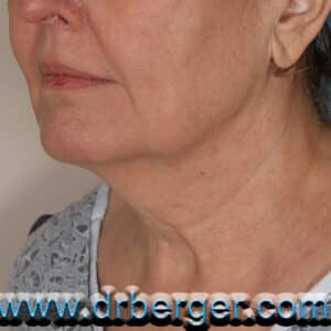 Face/Neck Lift