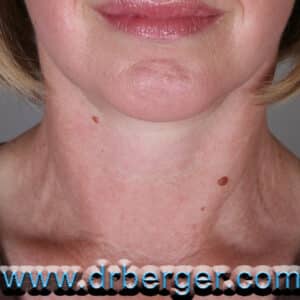 Face/Neck Lift