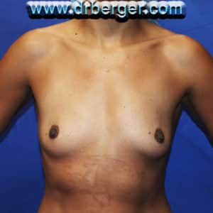 Breast Augmentation  – Case 21
