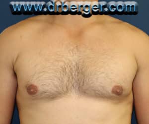 Gynecomastia – Case 4