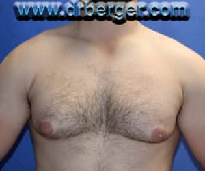 Gynecomastia – Case 4