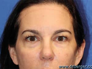 Blepharoplasty