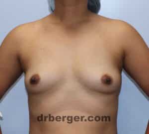 Breast Augmentation – Case 24
