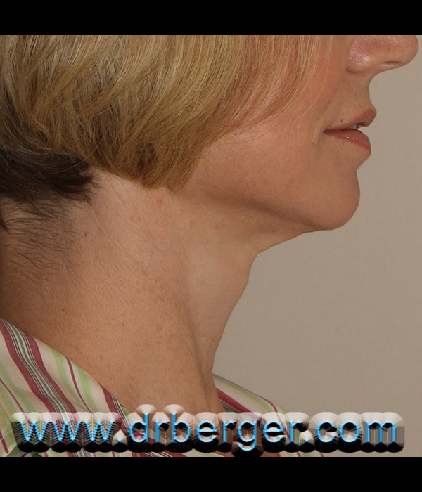After Image: Face/Neck Lift - right-side