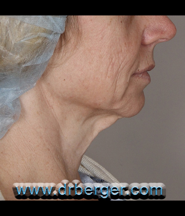 Before Image: Face/Neck Lift - right-side