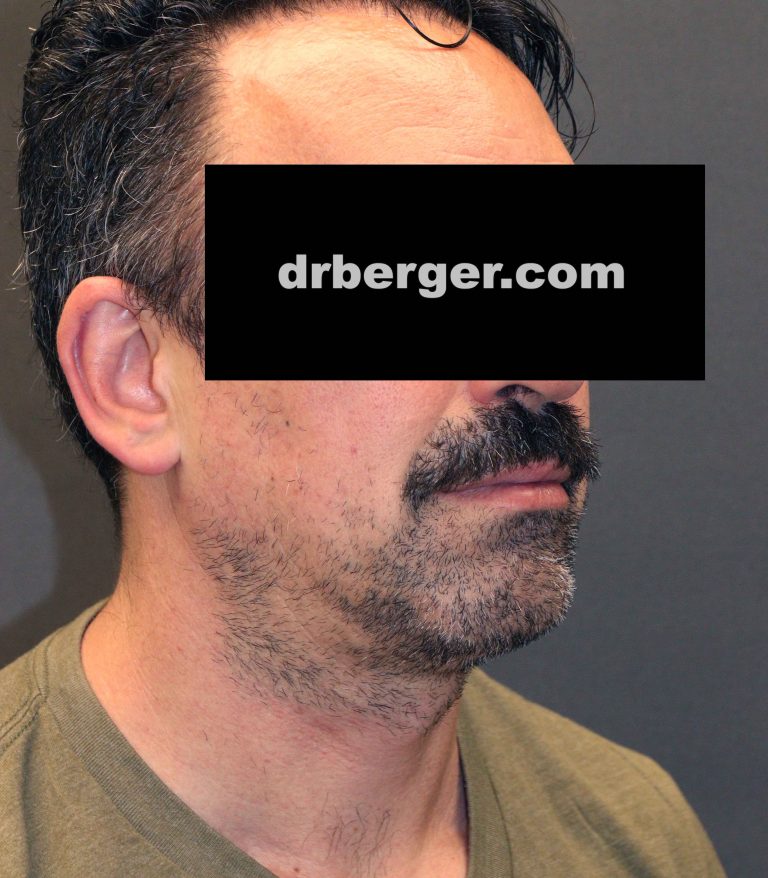 After Image: Chin augmentation with fat removal of the neck - right-front-oblique