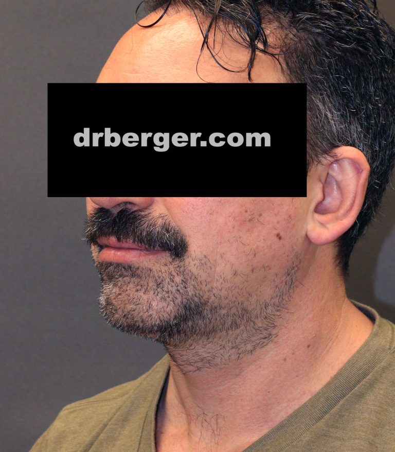 After Image: Chin augmentation with fat removal of the neck - left-front-oblique
