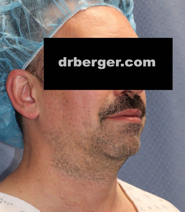 Before Image: Chin augmentation with fat removal of the neck - right-front-oblique