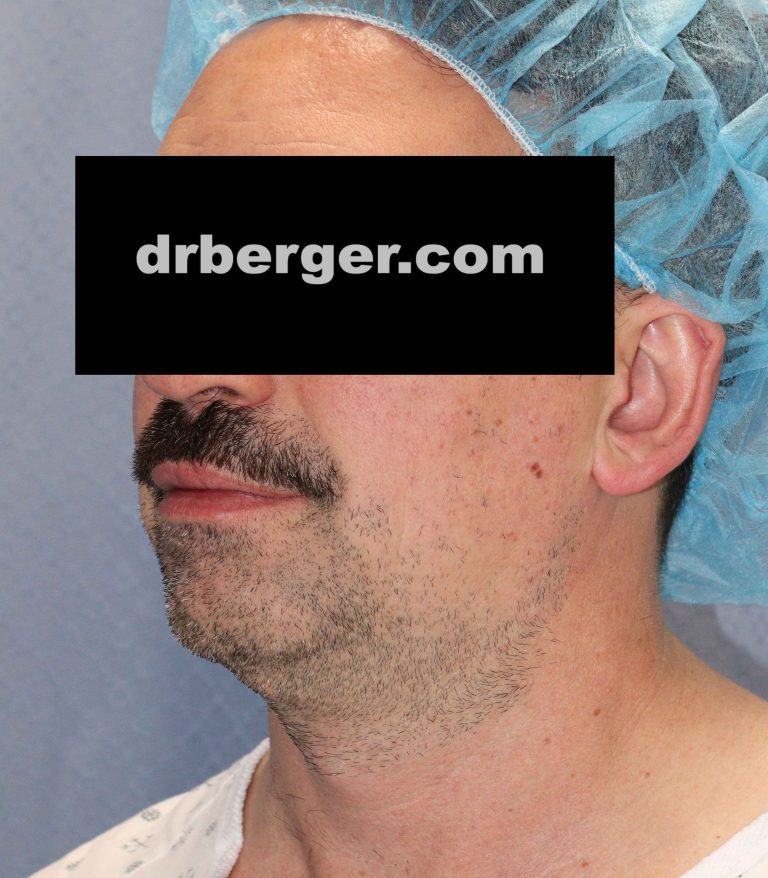 Before Image: Chin augmentation with fat removal of the neck - left-front-oblique