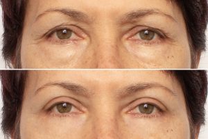 Close up of a woman having her nose drawn on in preparation for a rhinoplasty or nose reshaping surgery. Before and after of an older woman's eyes, who has received a blepharoplasty to remove excess skin and improve vision.