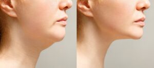 Close up of a woman having her nose drawn on in preparation for a rhinoplasty or nose reshaping surgery. Before and after image of a woman getting Kybella injections to slim her jawline profile.