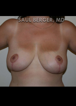 Breast Reduction – Case 14