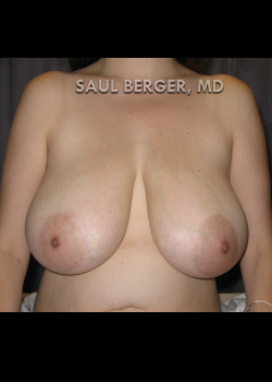 Breast Reduction – Case 14