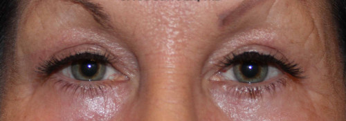 Blepharoplasty – Case 5