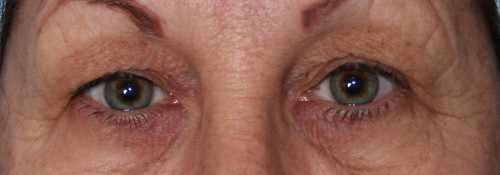 Blepharoplasty – Case 5