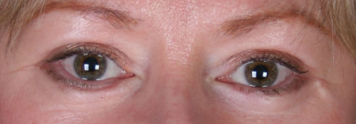 Blepharoplasty – Case 6