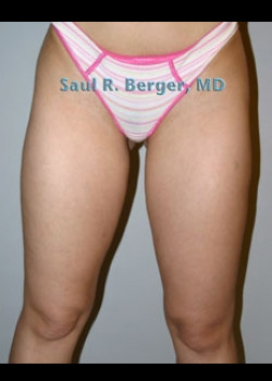 Liposuction – Case 4