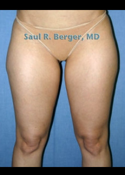 Liposuction – Case 4