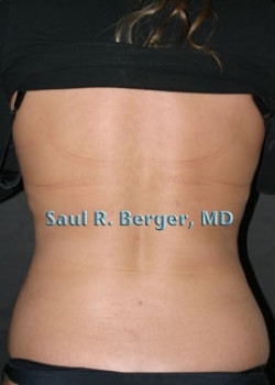 Liposuction – Case 5