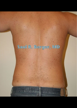 Liposuction – Case 6