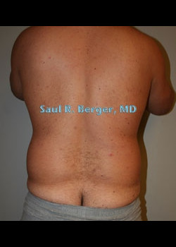 Liposuction – Case 6