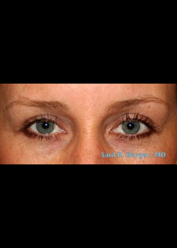 Blepharoplasty – Case 4