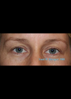 Blepharoplasty – Case 4