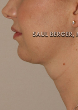 Kybella – Case 1