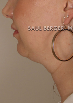 Kybella – Case 1