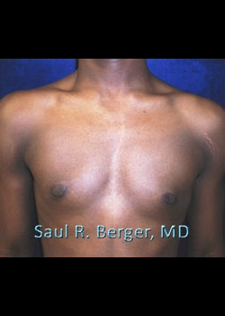 Gynecomastia – Case 3