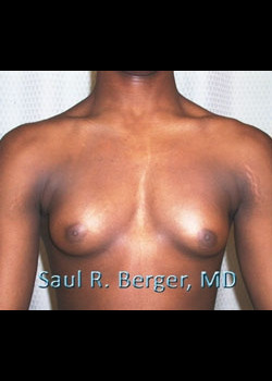 Gynecomastia – Case 3