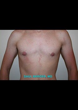 Gynecomastia – Case 1