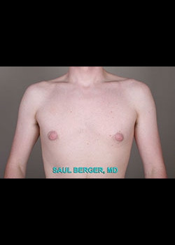 Gynecomastia – Case 1