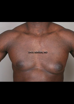 Gynecomastia – Case 2