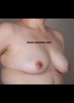 Breast Augmentation – Case 2