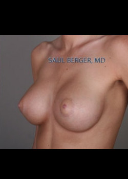 Breast Augmentation – Case 5