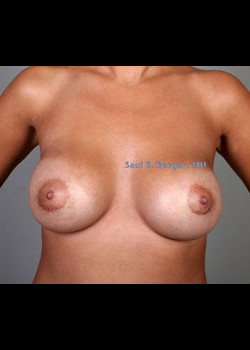 Breast Augmentation – Case 8