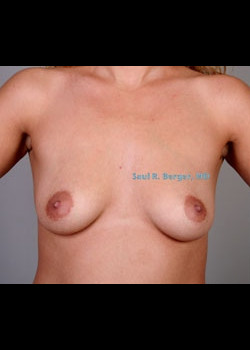 Breast Augmentation – Case 8