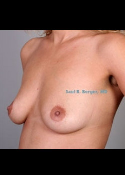 Breast Augmentation – Case 8