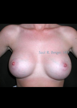 Breast Augmentation – Case 9