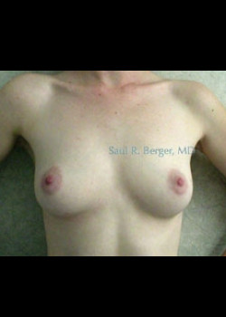 Breast Augmentation – Case 9